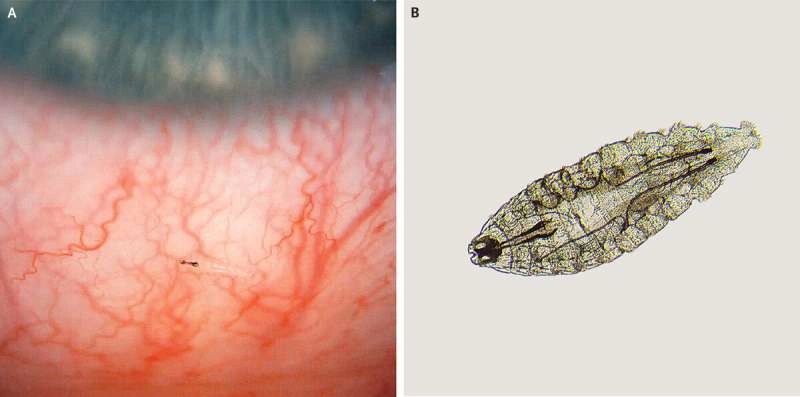 Hàng chục con ấu trùng ruồi làm tổ trong mắt người đàn ông ở Pháp-1