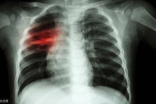 Người đàn ông 43 tuổi nhận chẩn đoán mắc ung thư phổi sau khi thấy tức ngực, bác sĩ cảnh báo nếu có 3 biểu hiện này vào buổi sáng thì đa phần là ung thư phổi-1
