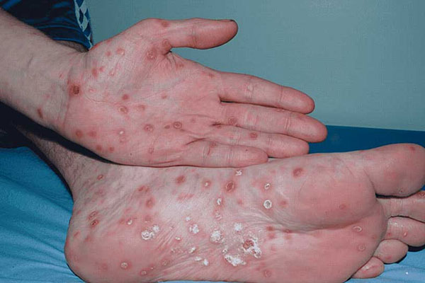 Quan hệ tình dục bừa bãi, nam thanh niên 22 tuổi ở Hà Nội nhận trái đắng-1