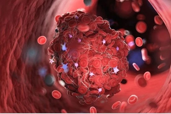 COVID-19 có thể làm tăng nguy cơ mắc chứng đông máu hiếm gặp ở mắt