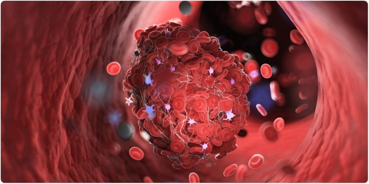 COVID-19 có thể làm tăng nguy cơ mắc chứng đông máu hiếm gặp ở mắt-1