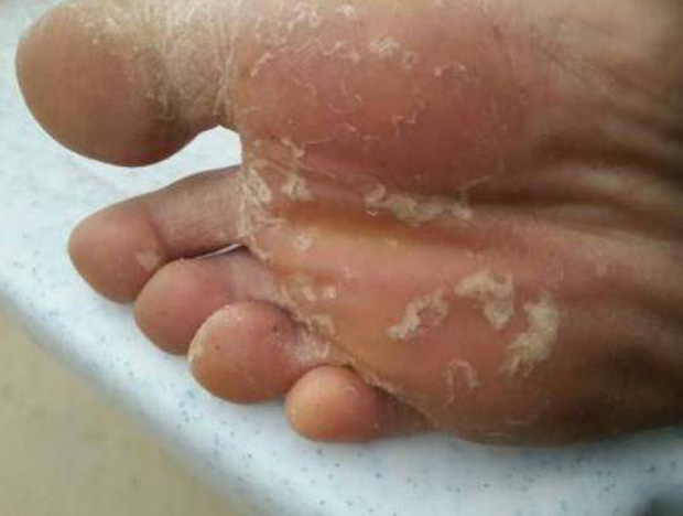 Lòng bàn chân có 3 dấu hiệu bất thường ngầm cảnh báo gan đang lên tiếng cầu cứu, bạn nhớ đừng chủ quan bỏ qua-1