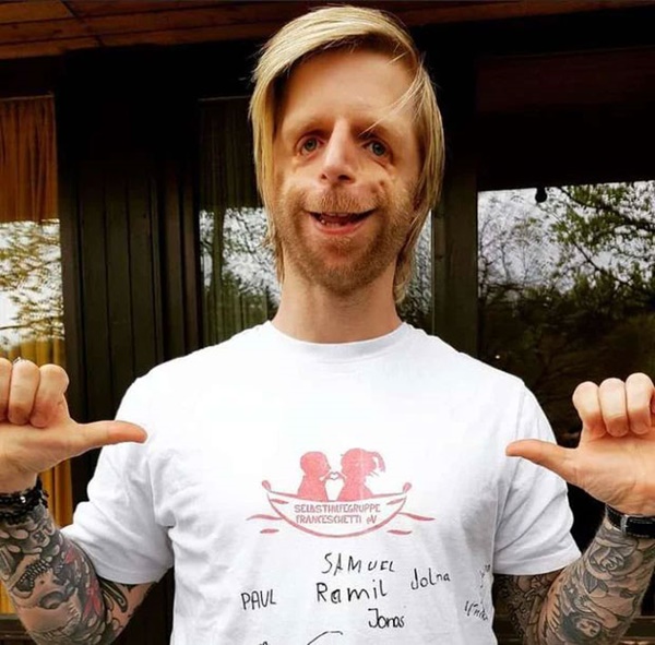 Chàng trai mặt chim bị bố mẹ chối bỏ tận 2 lần vì quá xấu xí, 30 năm sau khiến tất cả ghen tỵ với cuộc đời viên mãn bên người vợ xinh đẹp-3