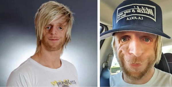 Chàng trai mặt chim bị bố mẹ chối bỏ tận 2 lần vì quá xấu xí, 30 năm sau khiến tất cả ghen tỵ với cuộc đời viên mãn bên người vợ xinh đẹp-4