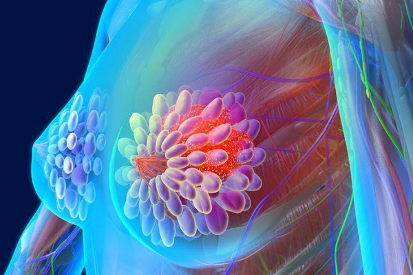 Thi thoảng đau nhói theo kiểu kim châm ở vú, cẩn thận với ung thư vú-1