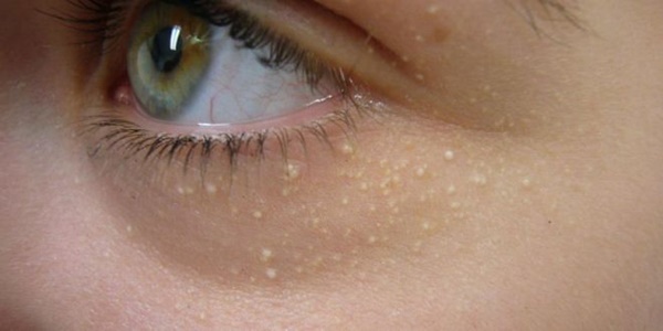 Dân văn phòng có 5 thay đổi này ở mắt cần phải đi khám ngay vì đó là dấu hiệu của bệnh, thậm chí là ung thư-3