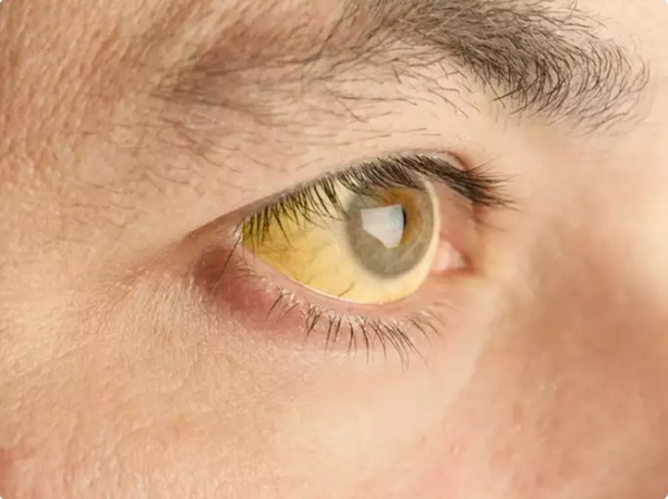 Dân văn phòng có 5 thay đổi này ở mắt cần phải đi khám ngay vì đó là dấu hiệu của bệnh, thậm chí là ung thư-4