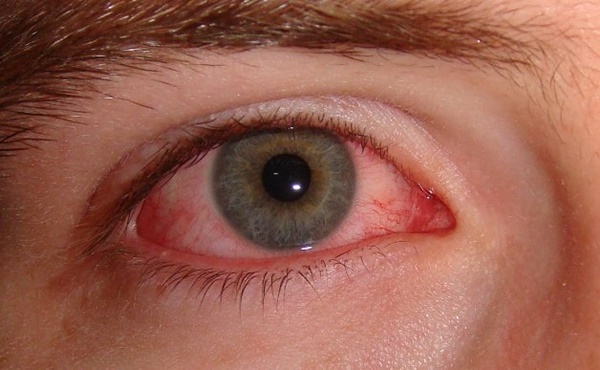 Dân văn phòng có 5 thay đổi này ở mắt cần phải đi khám ngay vì đó là dấu hiệu của bệnh, thậm chí là ung thư-5