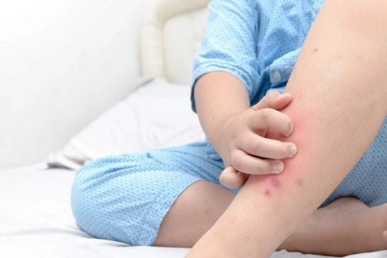 Dấu hiệu trên da cảnh báo di chứng hậu Covid-19 ở trẻ