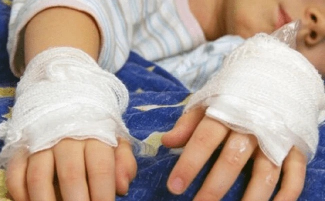 Con bị bỏng nước sôi 100 độ sưng rộp bàn tay, người mẹ vẫn bình tĩnh làm việc này ai ngờ được bác sĩ khen hết lời-2