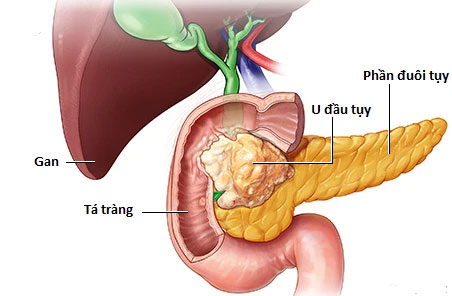 Loại ung thư có tiên lượng rất xấu, có dấu hiệu đã ở giai đoạn muộn: Ai có nguy cơ cao?-1