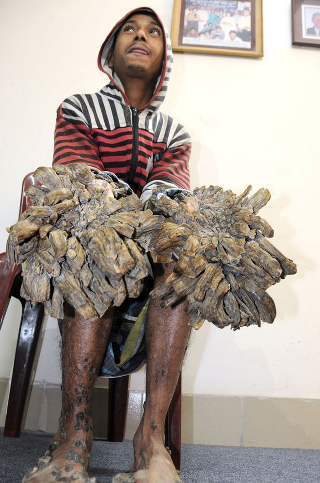 Chàng trai người cây” với đôi tay mọc rễ ai nhìn cũng nổi da gà, ngày ngày ao ước được cắt cụt tay vì quá đau đớn bây giờ ra sao?-2