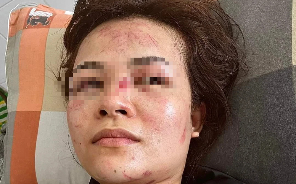Người phụ nữ tố cáo chồng bạo hành 9 năm, ly dị rồi vẫn bị đánh-1
