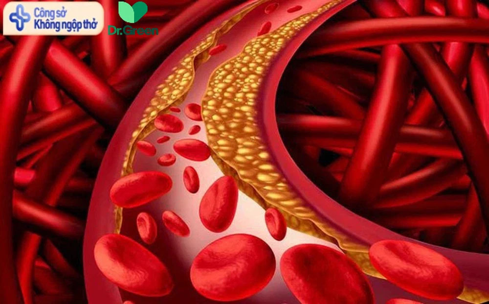 Gầy như xác ve vẫn máu nhiễm mỡ: Bác sĩ chỉ ra thủ phạm cả triệu dân văn phòng mắc-1