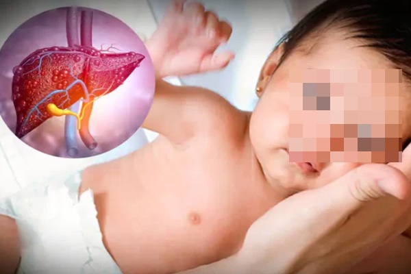 Nước châu Á đầu tiên phát hiện ca nghi mắc bệnh viêm gan bí ẩn-2