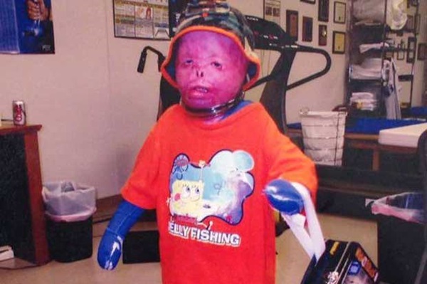 Cậu bé người ngoài hành tinh” bị bỏng 95% cơ thể khiến cả thế giới thương cảm một thời giờ ra sao? Hình ảnh hiện tại rất đáng khâm phục-1