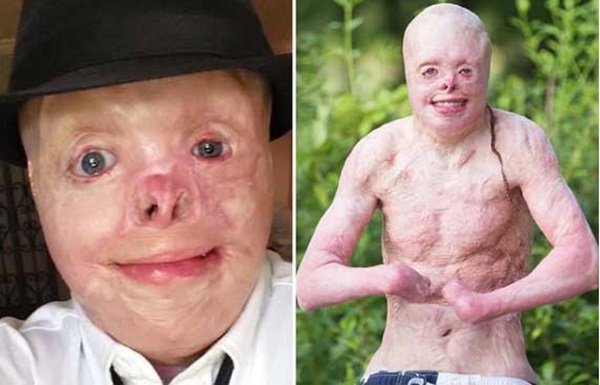 Cậu bé người ngoài hành tinh” bị bỏng 95% cơ thể khiến cả thế giới thương cảm một thời giờ ra sao? Hình ảnh hiện tại rất đáng khâm phục-4