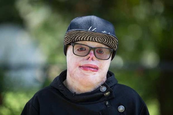 Cậu bé người ngoài hành tinh” bị bỏng 95% cơ thể khiến cả thế giới thương cảm một thời giờ ra sao? Hình ảnh hiện tại rất đáng khâm phục-5