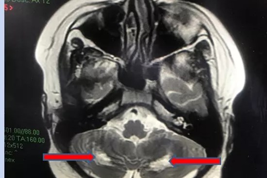 Mắc Covid-19, một học sinh bị tổn thương thần kinh