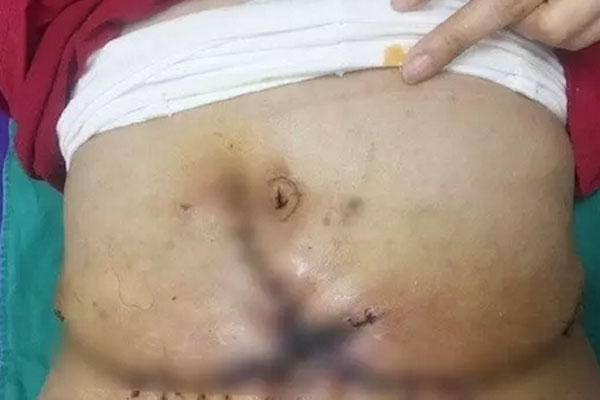 Cảnh báo hút mỡ hỏng: Bác sĩ chỉ ra nguyên nhân tiềm ẩn đằng sau-1