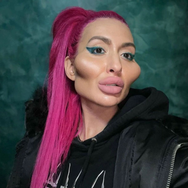 Cô gái nhận kỷ lục có gò má cao nhất thế giới, vẫn quyết tâm bơm cao thêm khiến bác sĩ phải cấm vì quá nguy hiểm-2