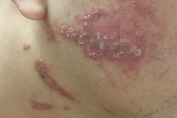 Sai lầm trong điều trị tổn thương do kiến ba khoang-3