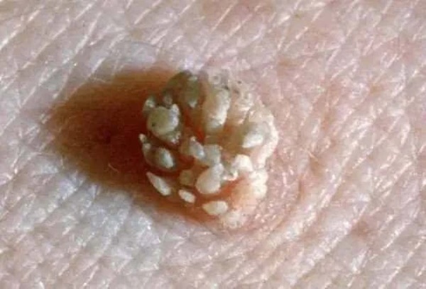 Phụ nữ bị nổi mụn cóc ở 3 vị trí này trên cơ thể: Coi chừng đã nhiễm HPV, tiềm ẩn nguy cơ ung thư cổ tử cung hoặc bệnh xã hội-2