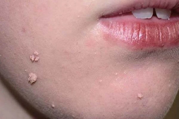Phụ nữ bị nổi mụn cóc ở 3 vị trí này trên cơ thể: Coi chừng đã nhiễm HPV, tiềm ẩn nguy cơ ung thư cổ tử cung hoặc bệnh xã hội-3