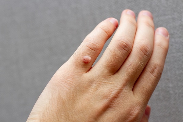 Nữ sinh 18 tuổi đột nhiên mọc mụn kín mặt, tưởng căng thẳng vì thi đại học ai ngờ phát hiện nhiễm virus HPV dù chưa từng quan hệ cũng không có bạn trai-5