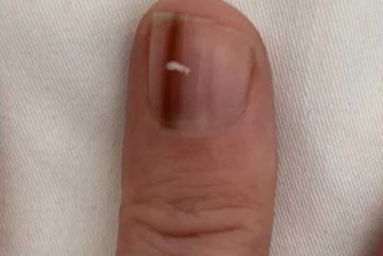 Đi khám vì dấu vết lạ trên móng tay, người phụ nữ sốc khi phát hiện thủ phạm đáng sợ