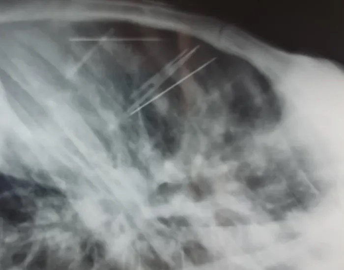 Stress, người phụ nữ tự đâm 7 chiếc kim khâu vào lồng ngực-1