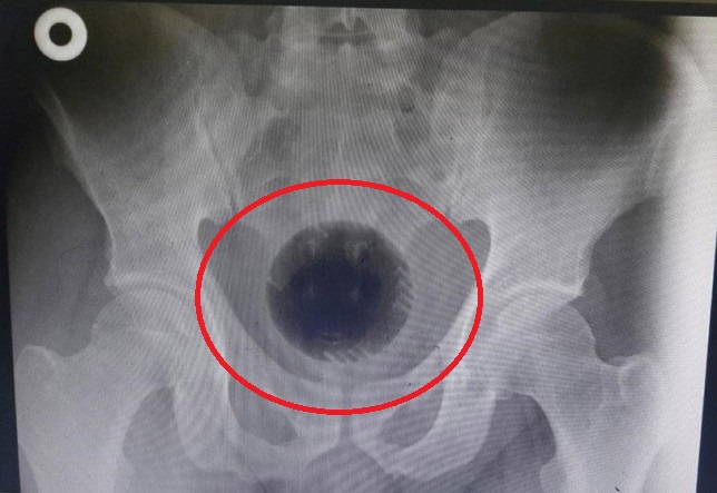 Đến viện vì đau bụng đến phát khóc, vật lấy từ bụng bệnh nhân khiến ai nấy đều sững sờ-1