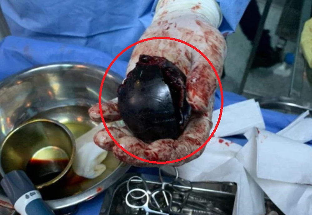 Đến viện vì đau bụng đến phát khóc, vật lấy từ bụng bệnh nhân khiến ai nấy đều sững sờ-3