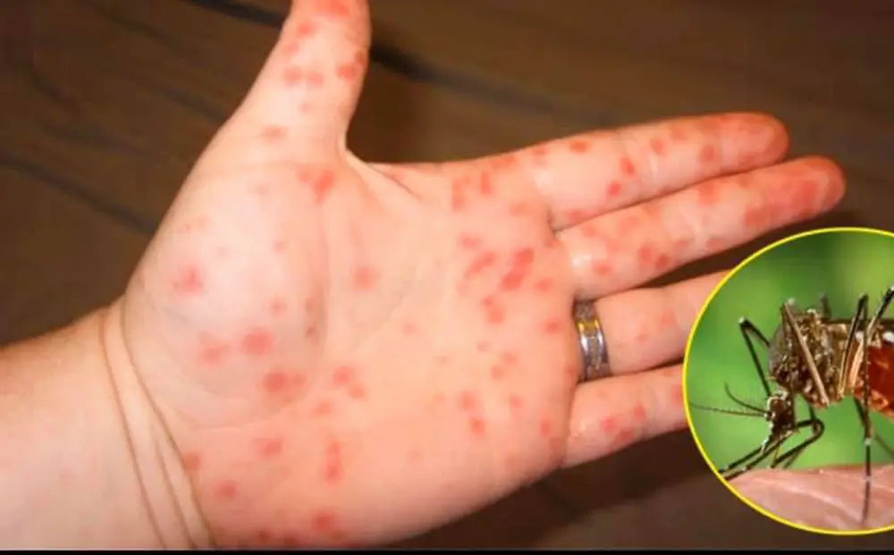 4 giai đoạn của bệnh sốt xuất huyết: Giai đoạn 3 cần chú ý vì dễ nguy hiểm-1