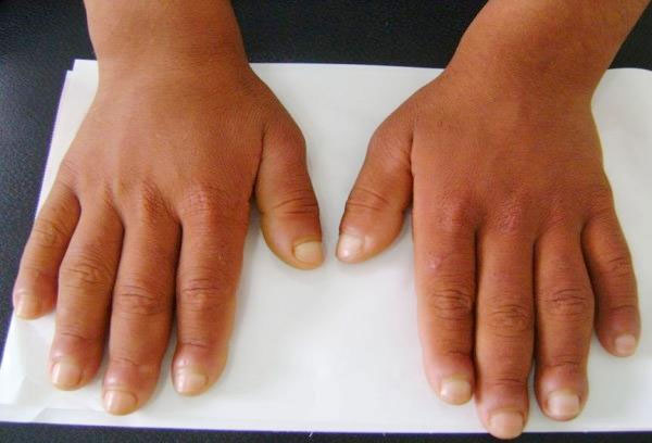 Các dấu hiệu ở tay cảnh báo tim bất ổn-2