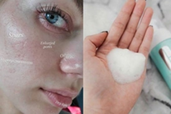 Dành cho nàng da dầu: Bác sĩ da liễu chỉ rõ bước skincare cân mọi loại dầu nhờn trong mùa Hè