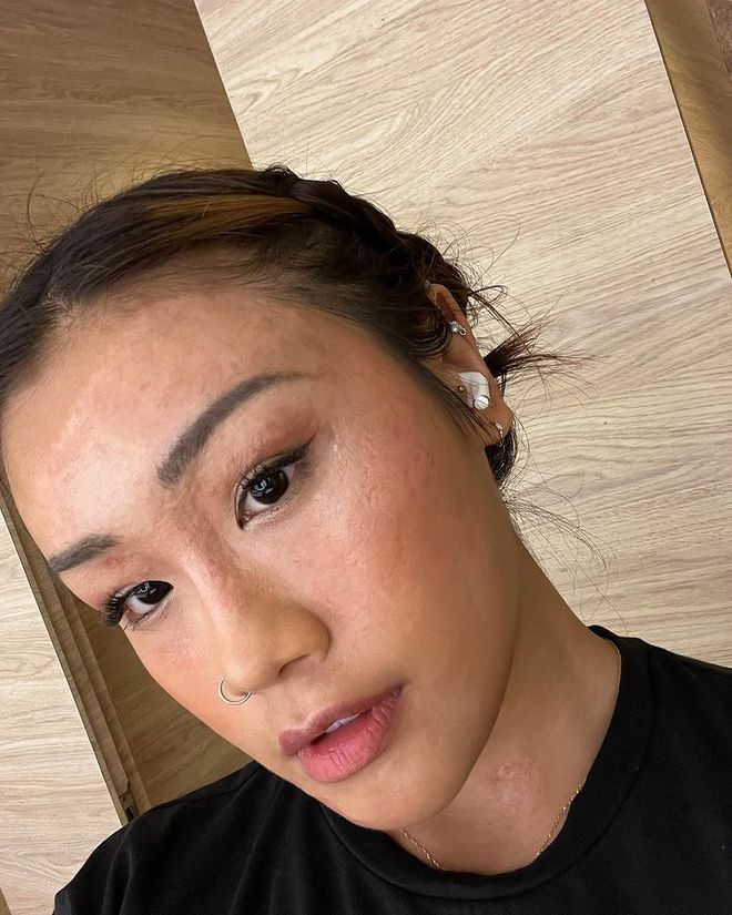 Bị bỏng nặng 75% gương mặt do nổ chảo dầu, 2 năm sau cô gái trẻ tự tin khoe diện mạo mới gây ngỡ ngàng-3