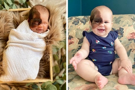 Cô bé sinh ra với vết bớt hiếm gặp trên mặt: Cách người mẹ dạy con tự tin, hay cười khiến ai cũng muốn học hỏi theo