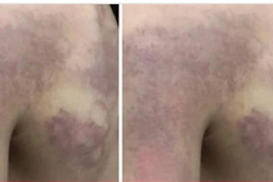 Tạm dừng đứng lớp với cô giáo đánh học sinh lớp 3 bầm tím lưng