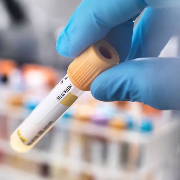 Số ca viêm gan bí ẩn ở trẻ trên thế giới chạm ngưỡng 300: 9 dấu hiệu không được bỏ qua-1