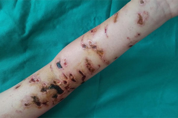 TPHCM: Hàng loạt người vào viện cầu cứu vì đi tắm biển gặp họa bỏng sứa-4