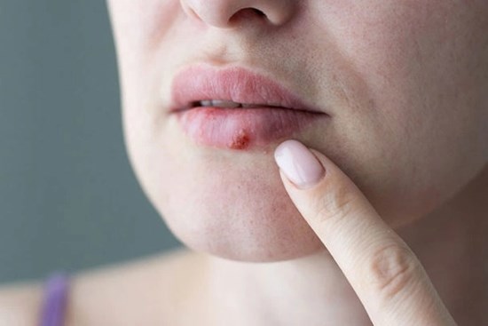 Căn bệnh được mệnh danh là 'nụ hôn thần chết'