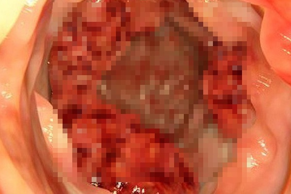 Bé 10 tuổi mang hậu môn nhân tạo do ung thư đại trực tràng: Bác sĩ cảnh báo dấu hiệu-1