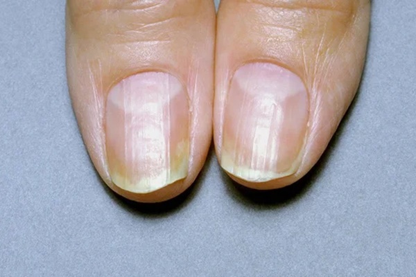 4 biểu hiện bất thường ở ngón tay giữa ngầm cảnh báo gan đang bị tổn thương, mong rằng bạn không gặp bất kỳ điều nào-2