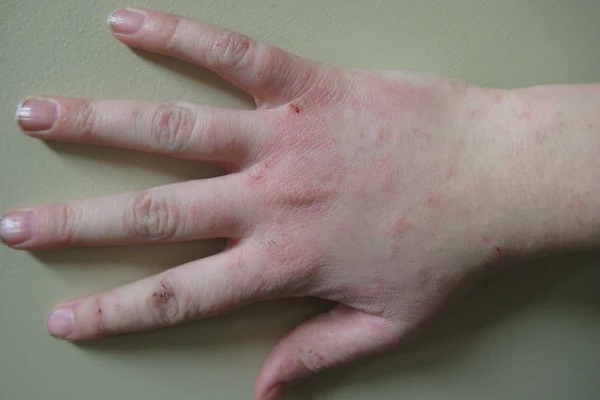 4 biểu hiện bất thường ở ngón tay giữa ngầm cảnh báo gan đang bị tổn thương, mong rằng bạn không gặp bất kỳ điều nào-4