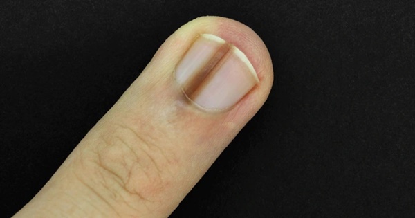 4 biểu hiện bất thường ở ngón tay giữa ngầm cảnh báo gan đang bị tổn thương, mong rằng bạn không gặp bất kỳ điều nào-1