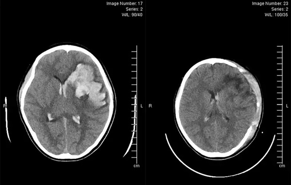 Bé trai 13 tuổi bị đột quỵ não-1