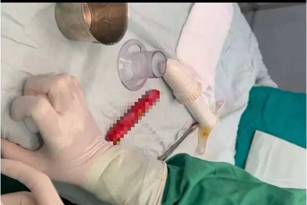 Chàng trai bị kẹt cây xúc xích ở hậu môn-1