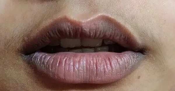 4 biểu hiện bất thường ở vùng đầu ngầm cảnh báo bệnh gan đang hoành hành, không cẩn thận còn là dấu hiệu của ung thư-2