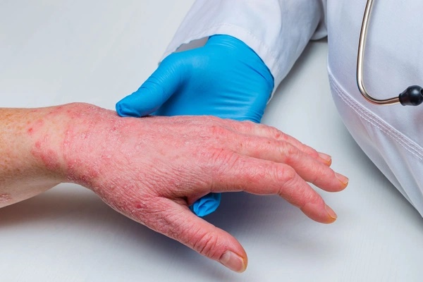 Lo ngại virus đậu mùa khỉ sẽ nối tiếp đại dịch COVID-19-2